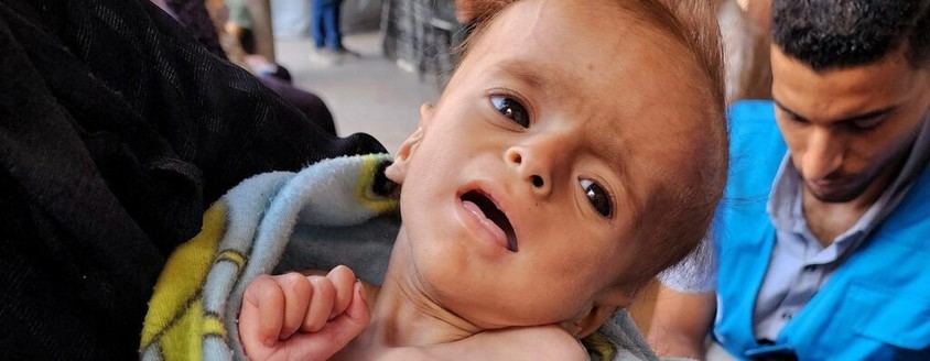 Crisis de desnutrición infantil en Gaza: más de 50 muertes desde el inicio del bloqueo