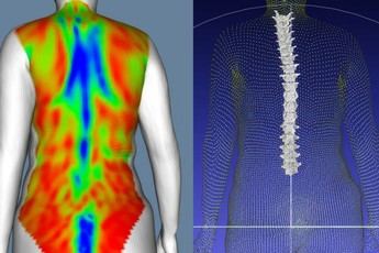 IBV innova en el diagnóstico de deformidades vertebrales con escaneo corporal sin radiación