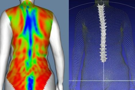 IBV innova en el diagnóstico de deformidades vertebrales con escaneo corporal sin radiación