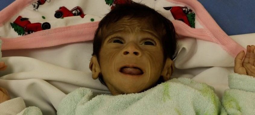 La OMS advierte sobre grave hambruna en Gaza debido al bloqueo israelí